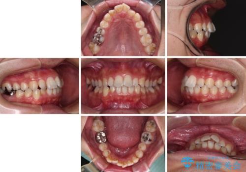前歯のデコボコと突出感をマウスピース矯正できれいにの治療前