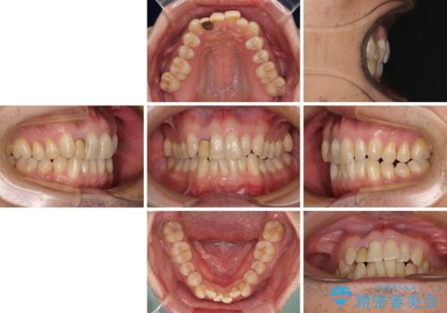 前歯のデコボコを治したい インビザラインによる矯正治療の治療前