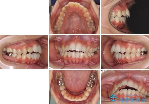 開咬と前突を改善　ワイヤー装置での抜歯矯正の治療前