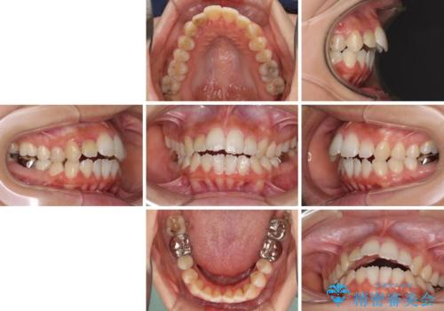 開咬と前突を改善 ワイヤー装置での抜歯矯正の治療前
