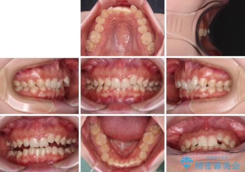 ディープバイトを短期間で改善　ワイヤー矯正治療の治療前