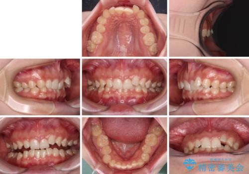 ディープバイトを短期間で改善 ワイヤー矯正治療の治療前