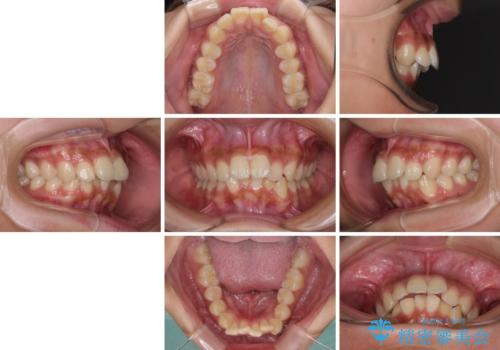 飛び出した前歯と八重歯を改善　ワイヤー装置での抜歯矯正の治療前
