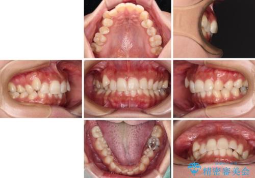 目立つ八重歯を改善　ワイヤー装置での抜歯矯正の治療前