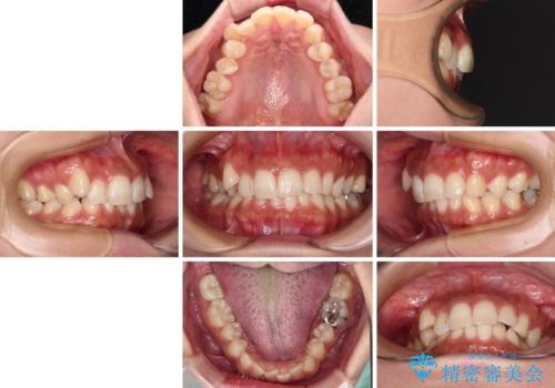 目立つ八重歯を改善 ワイヤー装置での抜歯矯正の治療前