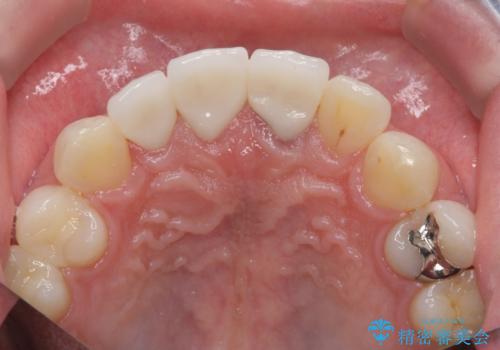 前歯の変色 審美性の改善の治療後