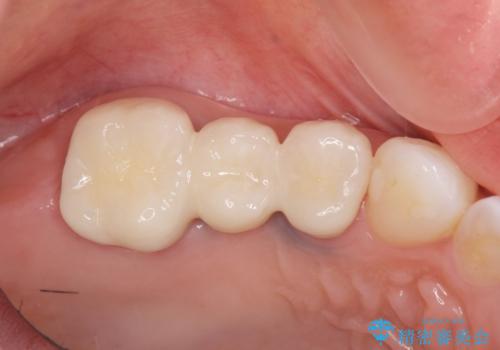 割れてしまった奥歯　セラミックブリッジ治療の治療後