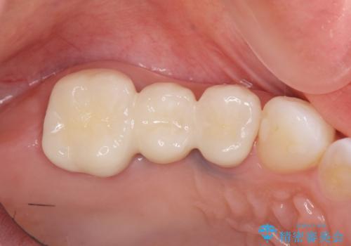割れてしまった奥歯 セラミックブリッジ治療の治療後