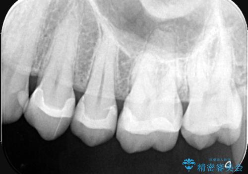 【セラミックインレー】虫歯になった詰め物部分を修復の治療後