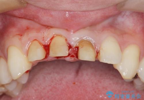 前歯の変色 審美性の改善の治療中