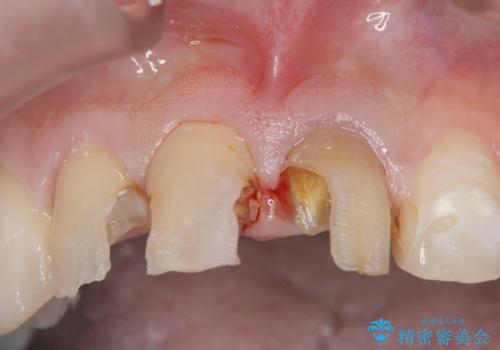 前歯の変色 審美性の改善の治療前