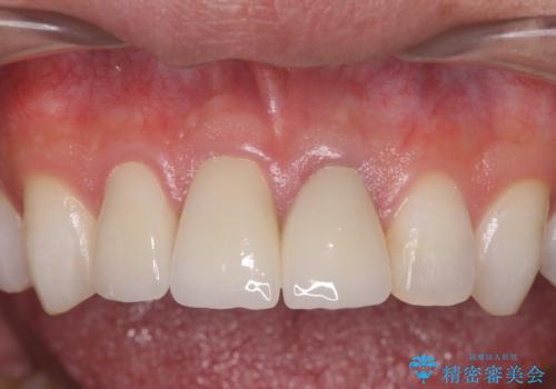 前歯の変色 審美性の改善の治療後