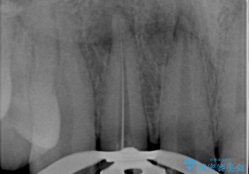 前歯の変色 審美性の改善の治療前