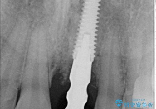 【1Dayインプラント】審美性を考えたインプラントの治療中