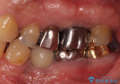 歯が割れているといわれた 奥歯にインプラントをしていきたい 全体的な治療の治療後