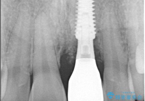 【1Dayインプラント】審美性を考えたインプラントの治療後