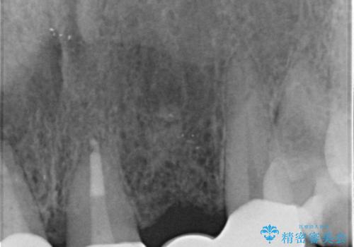 入れ歯を変えたい ブリッジでの修復治療の治療後