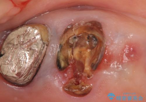 過大な咬合力で破折した奥歯　インプラント治療で咬合機能の回復の治療前