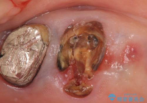 過大な咬合力で破折した奥歯 インプラント治療で咬合機能の回復の治療前
