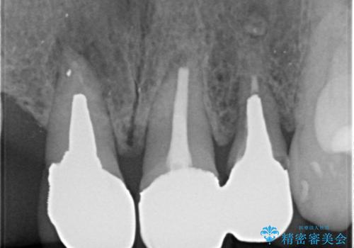 入れ歯を変えたい ブリッジでの修復治療の治療前