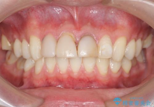 前歯の変色 審美性の改善の治療前