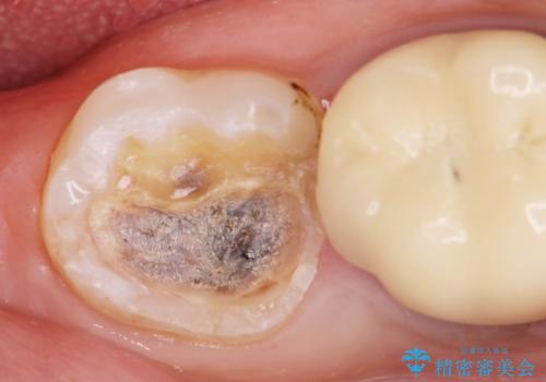 インレー下に再発した虫歯 セラミッククラウンによるやり替えの治療中
