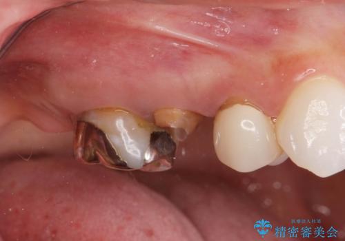 割れてしまった奥歯 セラミックブリッジ治療の治療前