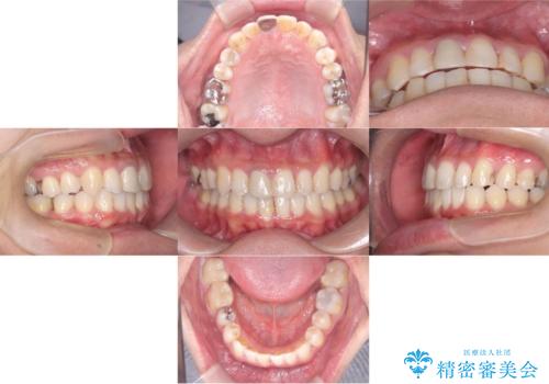 【インビザライン】八重歯と歯のでこぼこが気になる!の治療後