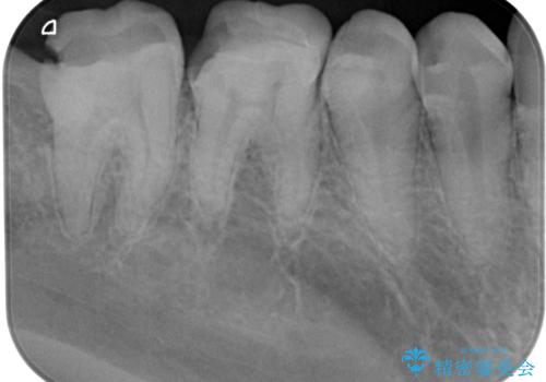 セラミックの詰め物が欠けたのでやり替えたい オールセラミッククラウンの治療前