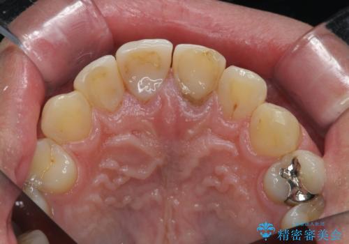 前歯の変色 審美性の改善の治療前