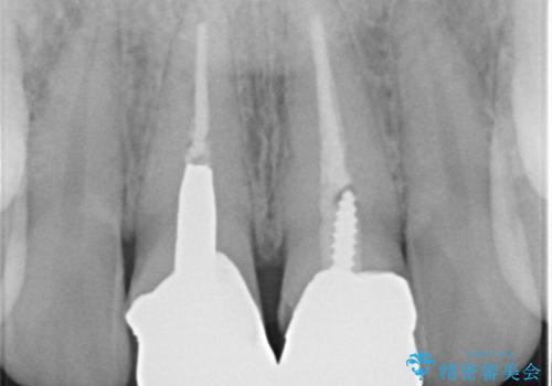 前歯を綺麗にしたい　e-maxクラウンでの修復の治療前