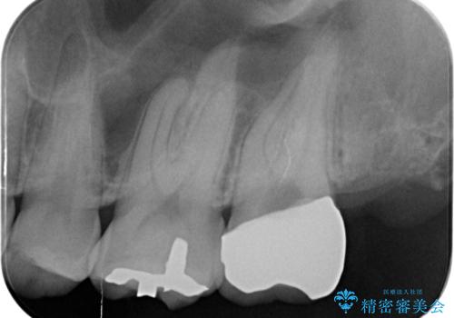 奥の虫歯　ジルコニアクラウンでの修復の治療後