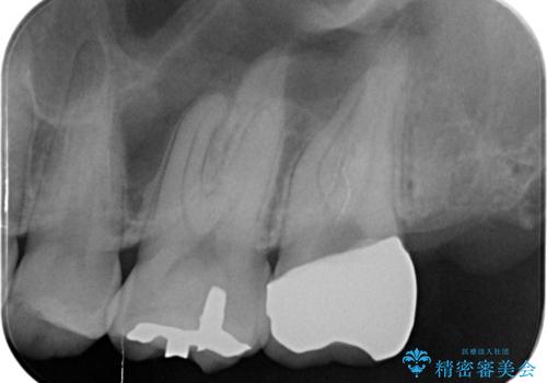 奥の虫歯 ジルコニアクラウンでの修復の治療後