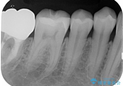 奥歯にセラミックを入れたいの治療後