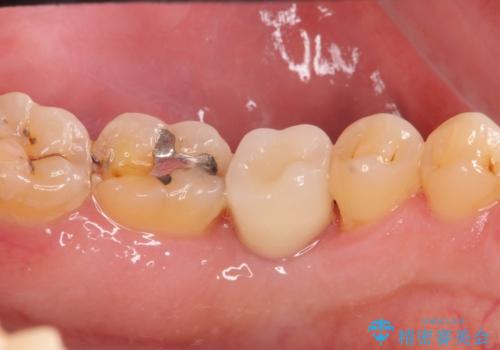 奥歯の欠損　インプラント治療の治療後