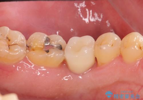 奥歯の欠損 インプラント治療の治療後