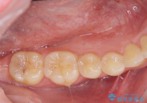 矯正の後戻りを防ぐ骨隆起の切除の症例 治療後