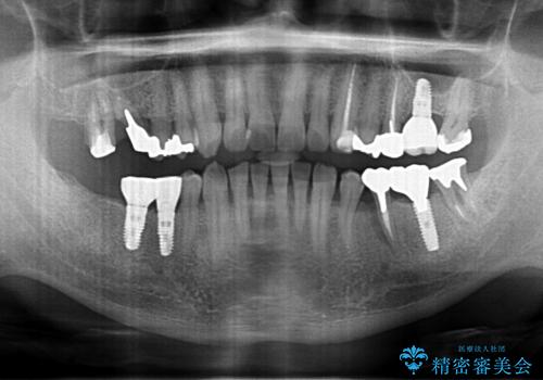 歯が割れているといわれた 奥歯にインプラントをしていきたい 全体的な治療の治療前