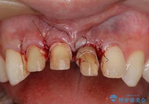 前歯の変色 審美性の改善の治療中
