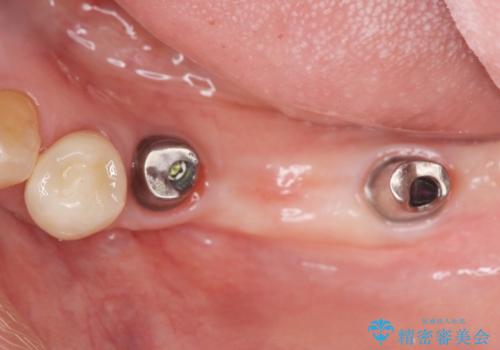 入れ歯を無くした インプラント治療の希望の治療中