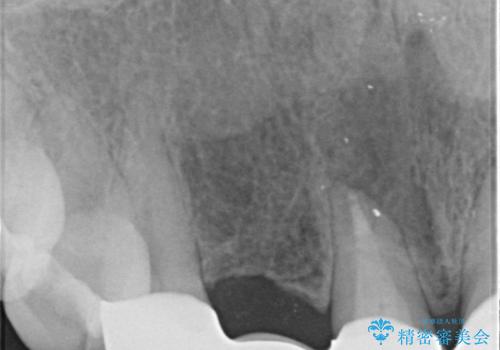 入れ歯を変えたい ブリッジでの修復治療の治療後