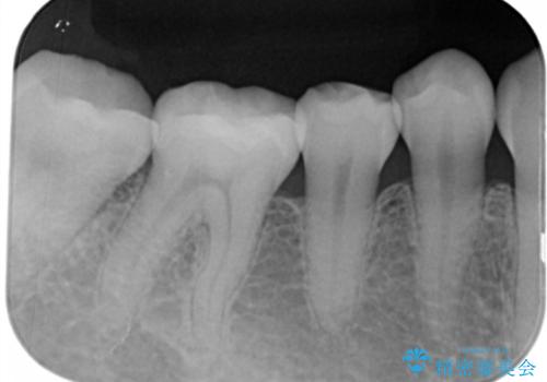 深い虫歯を綺麗なセラミックで修復!の治療後