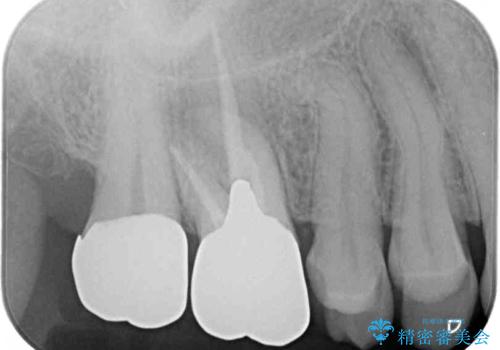 目立つ銀歯と欠けてしまった詰め物 オールセラミッククラウンでの補綴治療の治療前