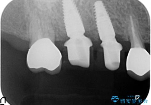 過大な咬合力で破折した奥歯　インプラント治療で咬合機能の回復の治療中