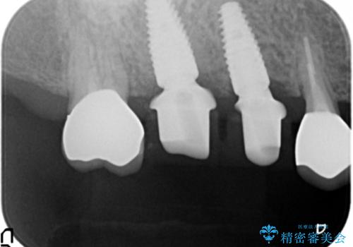 過大な咬合力で破折した奥歯 インプラント治療で咬合機能の回復の治療中