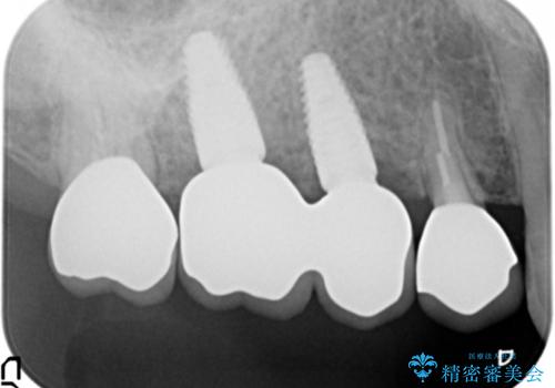過大な咬合力で破折した奥歯　インプラント治療で咬合機能の回復の治療後