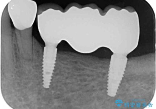 入れ歯を無くした インプラント治療の希望の治療後