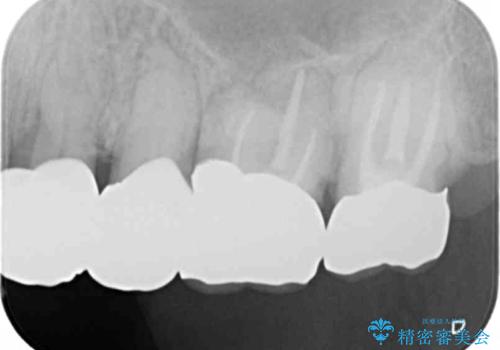 咬合の崩壊 金属床義歯で咬合機能の回復の治療前