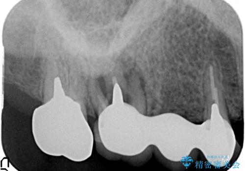 過大な咬合力で破折した奥歯　インプラント治療で咬合機能の回復の治療前