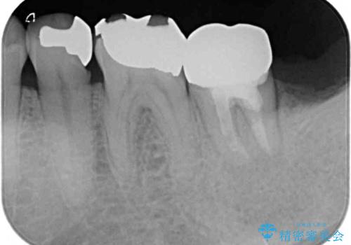 奥歯が痛い 破折した奥歯のインプラント治療の治療前